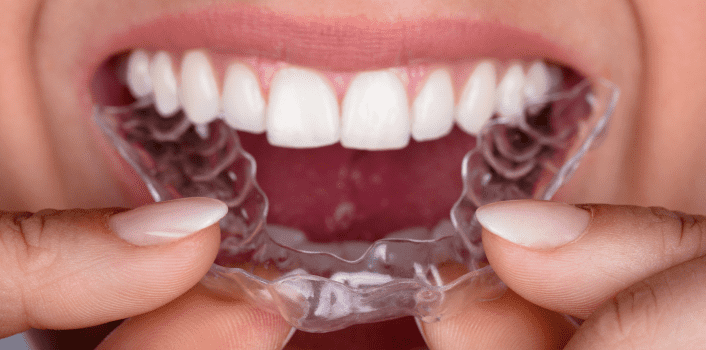 Clear Aligners Example